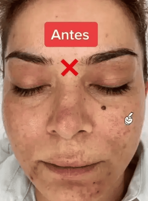 2x Pack Jabon de ácido Kojico Skincare®